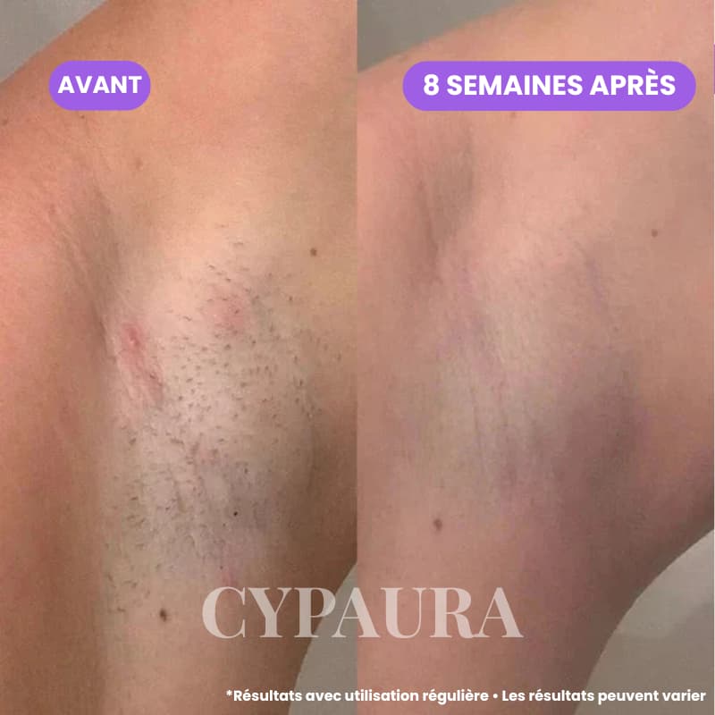 Sérum Botanique Anti-Repousse | Cypaura™