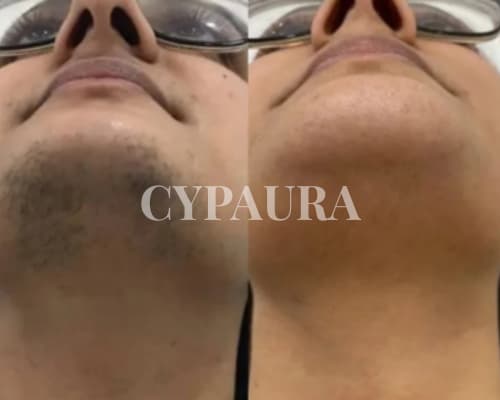 Cliente heureuse des résultats de l'huile anti-poils Cypaura