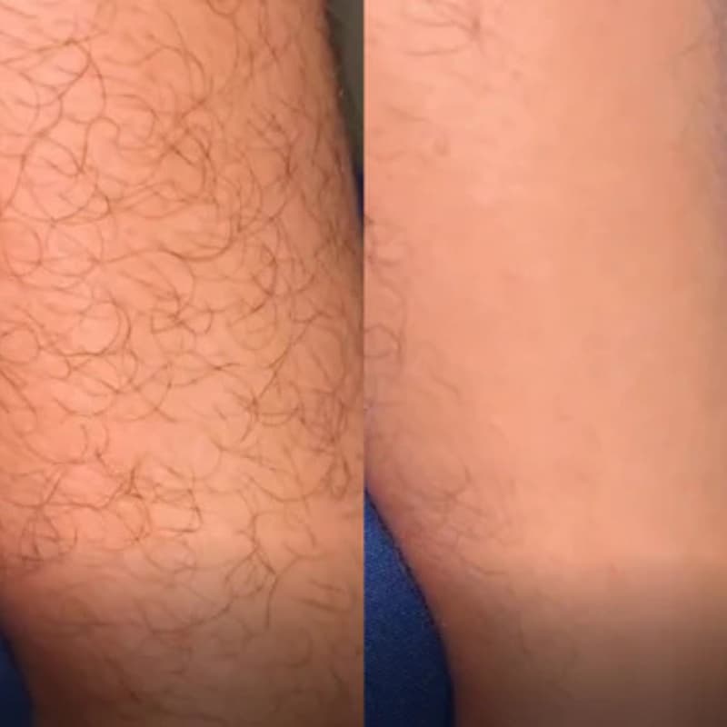 Avant/Après bras - Épilation efficace et douce gomme capillaire Crystal Image