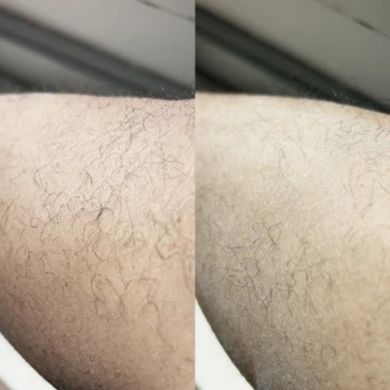 Avant/Après jambes complètes - Transformation totale gomme capillaire Crystal Image