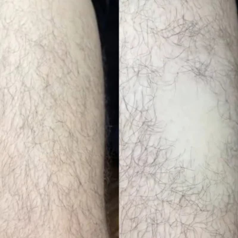 Avant/Après gros plan jambes - Résultats détaillés gomme Crystal peau lisse Image