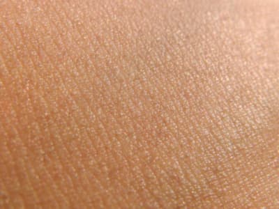 Disparition quasi-complète des poils après 3 mois de traitement naturel