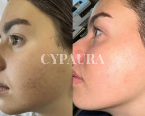 Résultat réel d'une utilisatrice de l'huile de Cyperus Rotundus