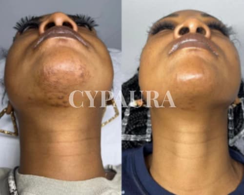 Témoignage d'une cliente satisfaite après traitement de la pilosité excessive